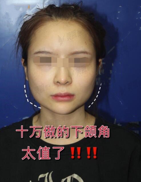 下颌角整形术全过程记录，有哪些不懂的看完日记就清楚啦~