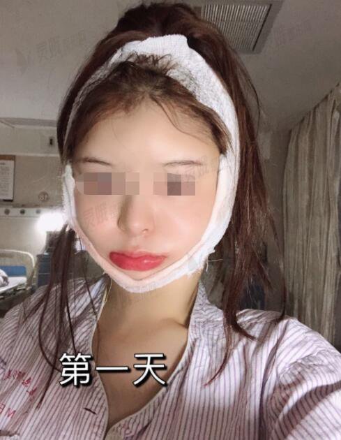 下颌角整形术手术过程