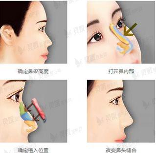隆鼻注意事项