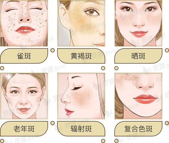 激光美肤激光祛斑
