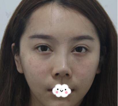 自体软骨隆鼻的果