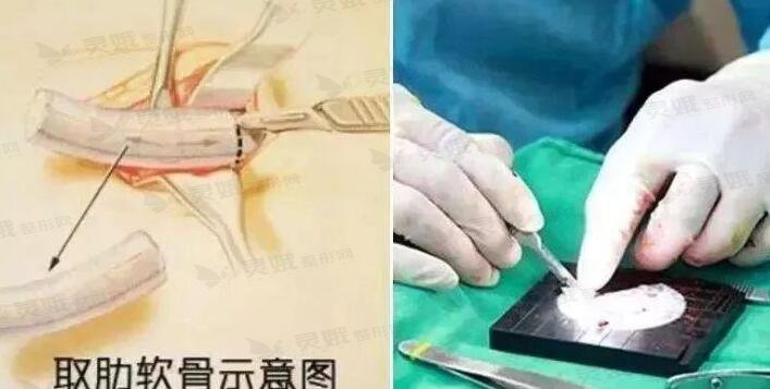 自体软骨隆鼻的价格