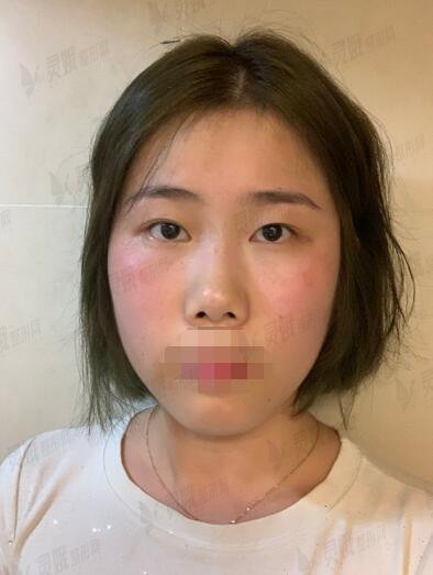 真人芭比眼部手术手术前