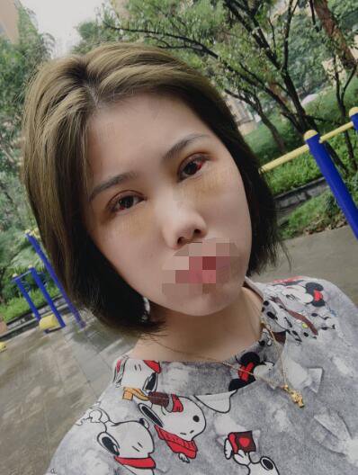 真人芭比眼部手术手术后一周