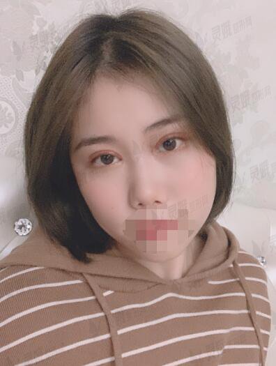 真人芭比眼部手术手术后4周