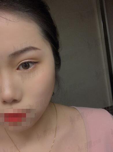 真人芭比眼部手术手术后果