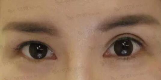眼睛不对称