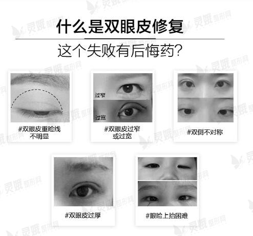 影响双眼皮修复价格的因素