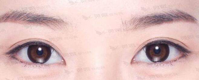 双眼皮平行的小V脸