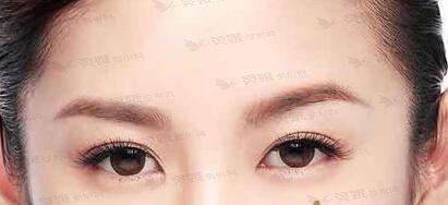 提眉手术的缺点是什么