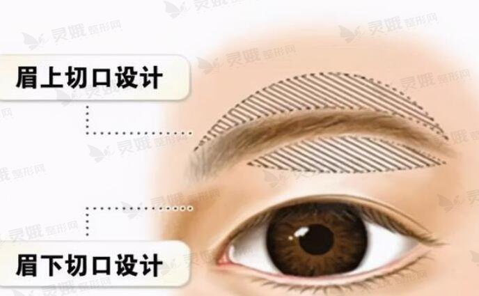 重现双眼皮