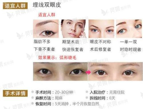 双眼皮手术还有什么方式?