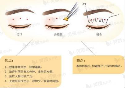 埋线双眼皮的优点?