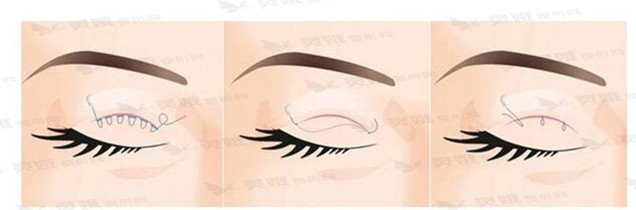 埋线双眼皮为什么受很多人的喜欢?