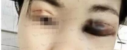 违法工作室割双眼皮的失败例子