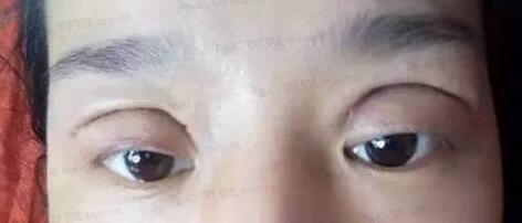 双眼皮太宽了