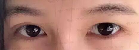 双眼皮不对称