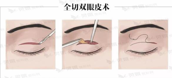 双眼皮方式不同影响价格