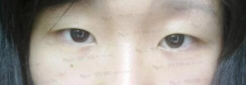 眼睑凹陷程度