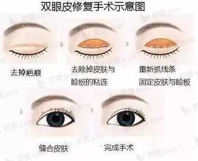 双眼皮修复手术时怎么做的