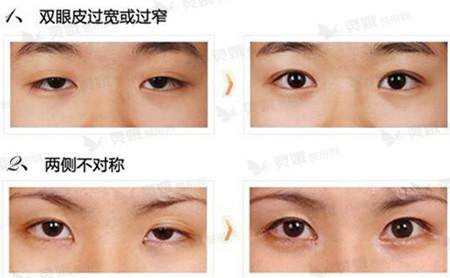 双眼皮修复方案：