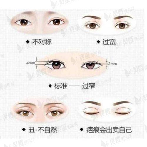 双眼皮修复手术难吗?
