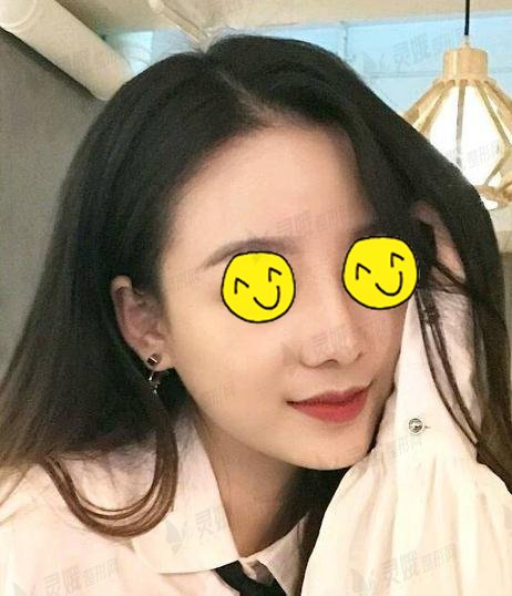驼峰鼻案例果图