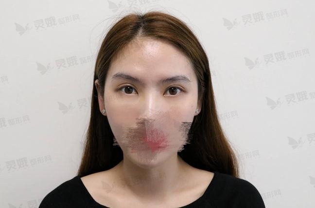 祛眼袋手术案例图