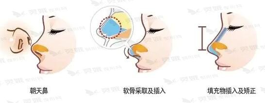 朝天鼻整形的方式