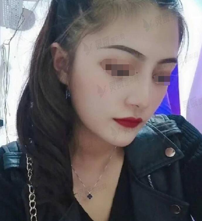 术后一个月