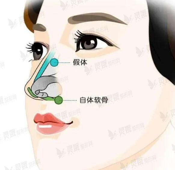 隆鼻整形术后怎么护理