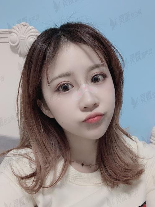 张金辉医生双眼皮案例：术后15天