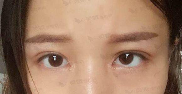 张金辉医生双眼皮案例