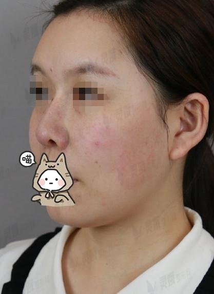 做鼻子案例分享——鼻小柱整形：术前