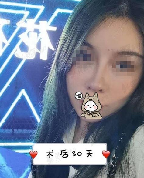 做鼻子案例分享——鼻小柱整形