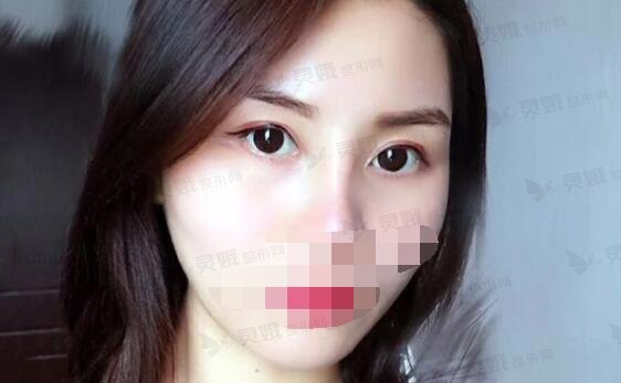 双眼皮8毫米恢复果图