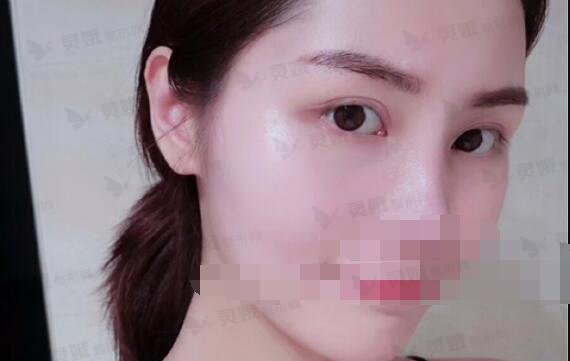 双眼皮8毫米恢复果图