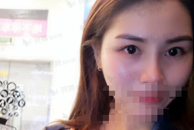 双眼皮8毫米恢复果图