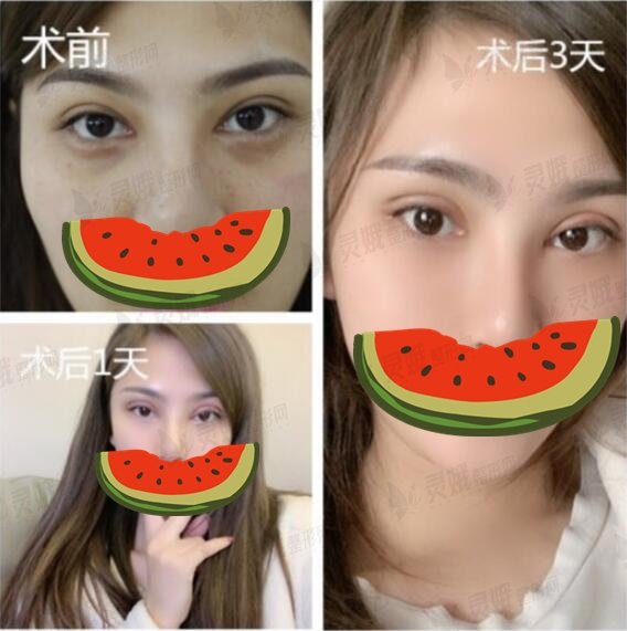 北京双眼皮修复手术