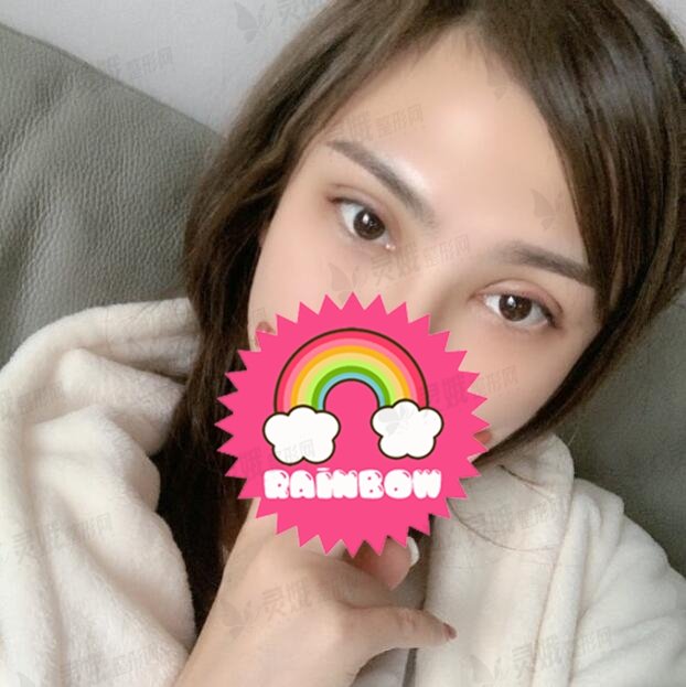 北京双眼皮修复手术