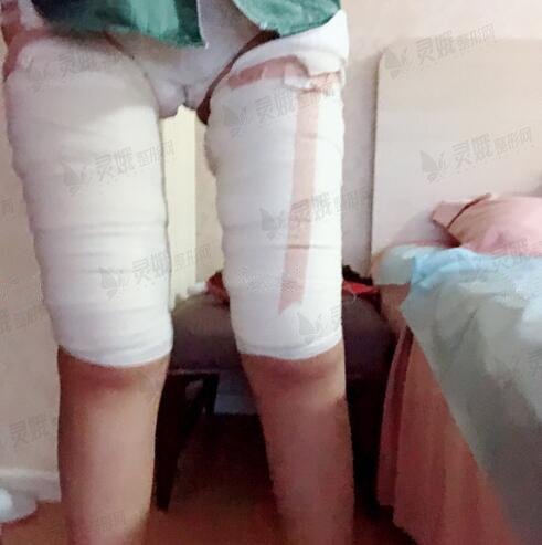 乔爱军脂肪修复果图