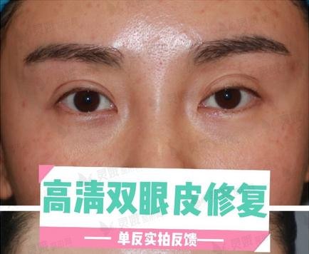 成都双眼皮修复果图