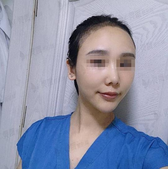 5000块钱做的发际线植发果图