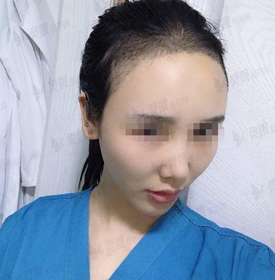 5000块钱做的发际线植发果图