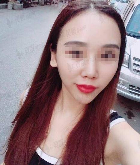 5000块钱做的发际线植发果图