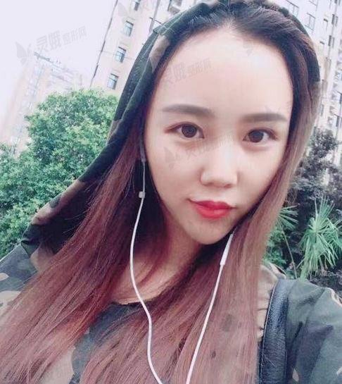 5000块钱做的发际线植发果图