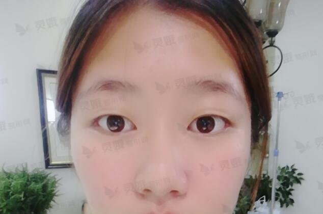 欧式双眼皮图片：真人做欧式双眼皮过程记录及术后恢复果，60天