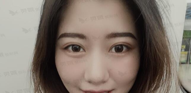 欧式双眼皮后57天