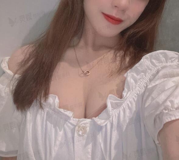 重庆牙祖蒙隆胸后一个月
