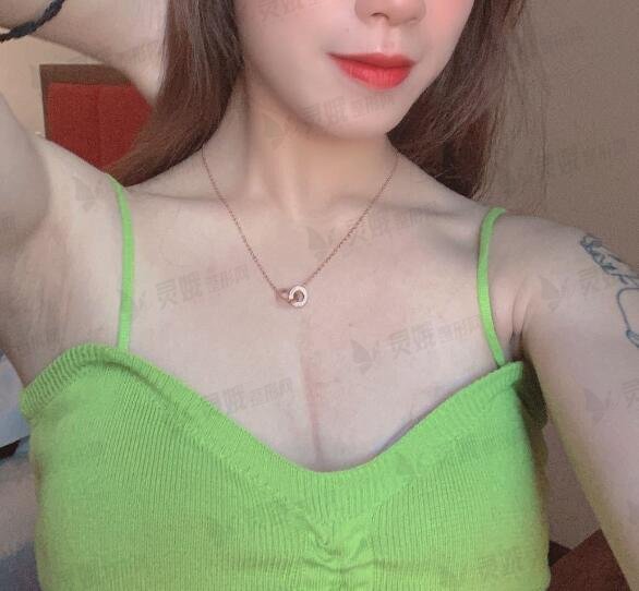 重庆牙祖蒙隆胸后4个月